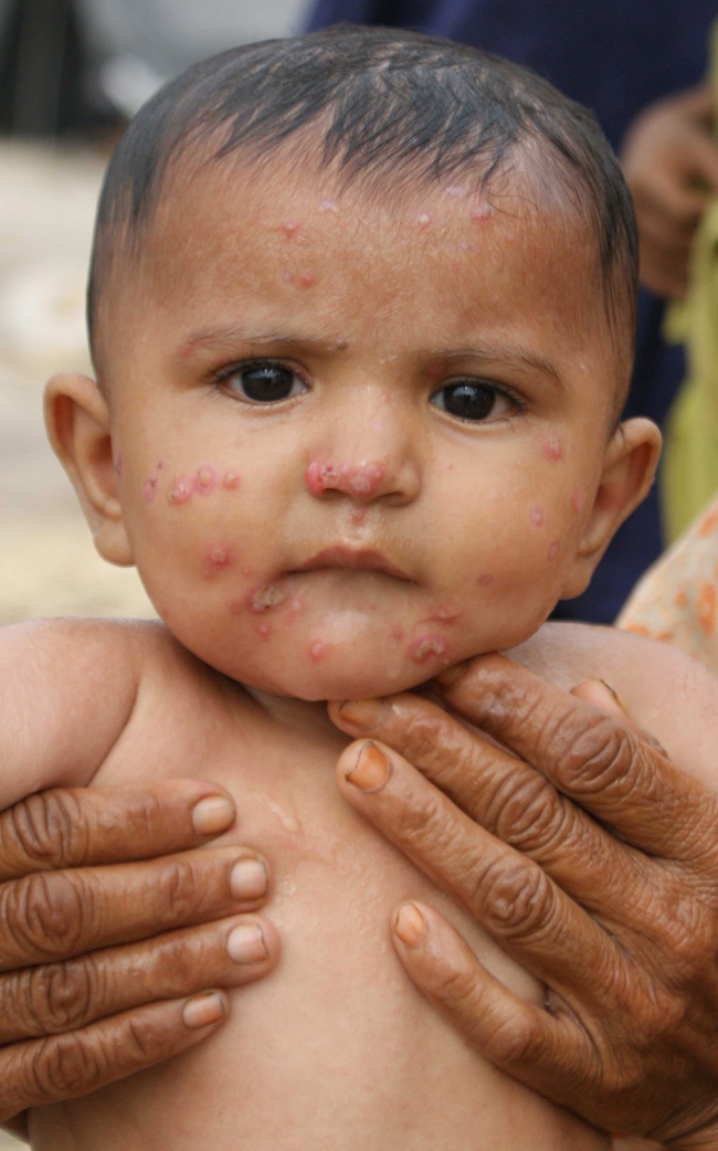 insuficiencia de vitamina d causa alergias en niños el siglo de torreón