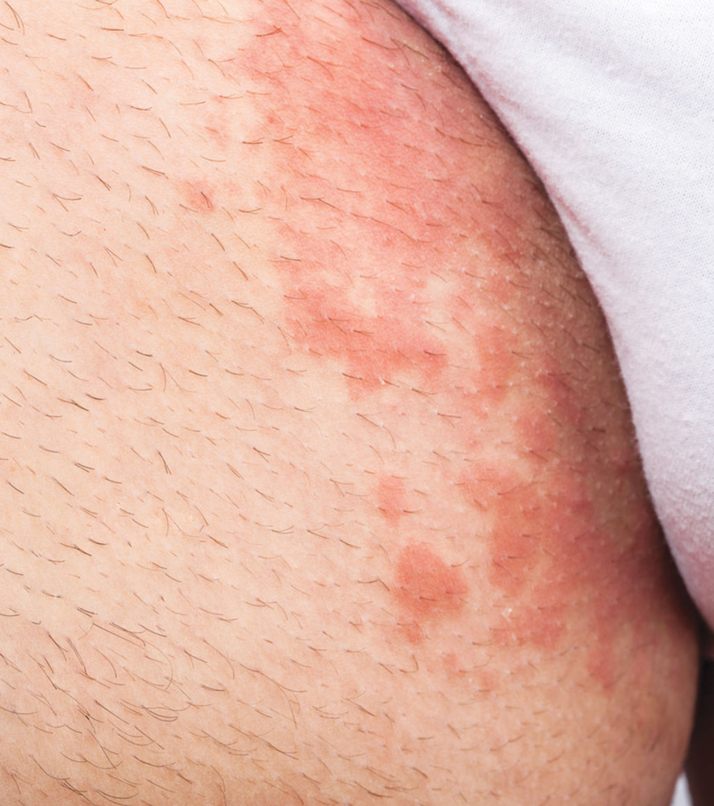 psoriasis female jock itch psoriasis female jock itch