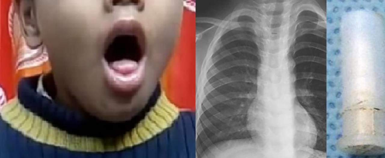 VIDEO: Niño se traga un silbato y suena cada vez que tose. Noticias en tiempo real