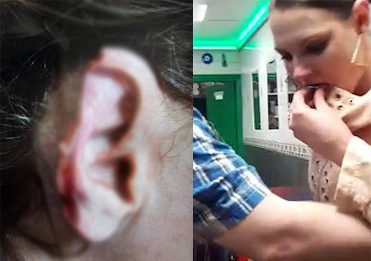 Mujer le muerde la oreja durante pelea y le quita una parte. Noticias en tiempo real