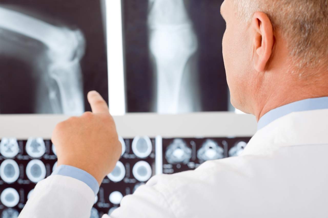 Osteoporosis es más frecuente en mujeres, pero más riesgosa en hombres. Noticias en tiempo real