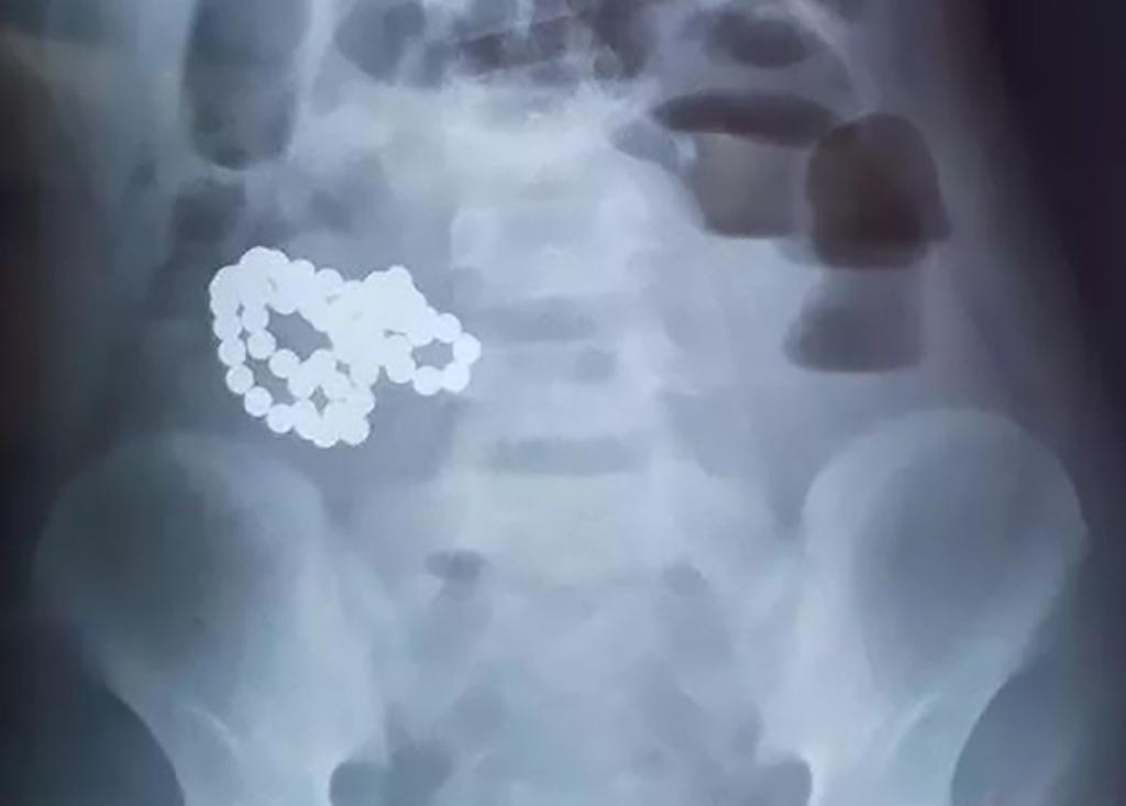 Extraen 61 bolas magnéticas del intestino de un niño. Noticias en tiempo real