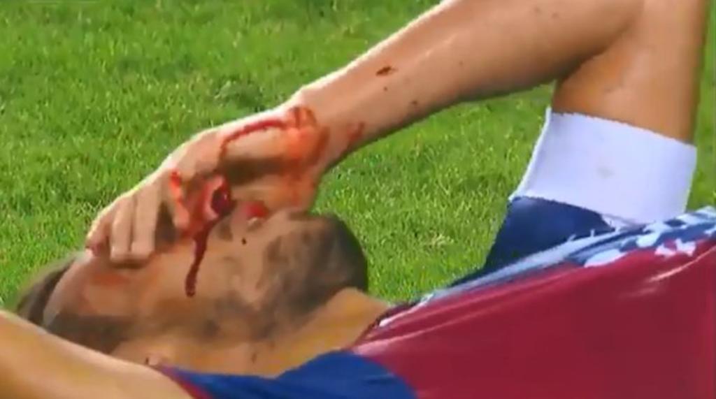Jugador del Atlante sufre una sangrienta lesión. Noticias en tiempo real