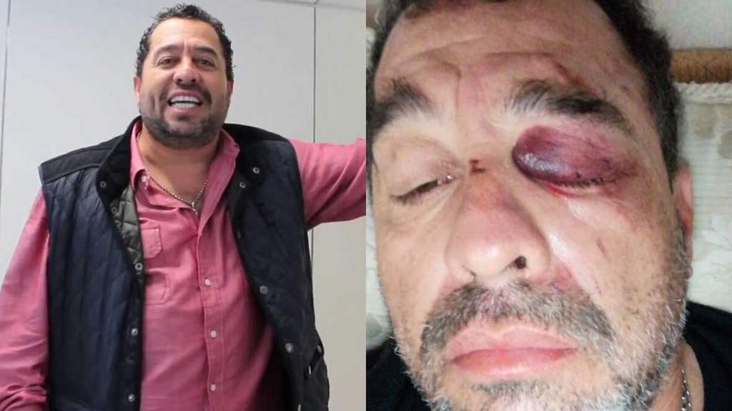 Borrego Nava muestra sus golpes tras accidente en moto. Noticias en tiempo real