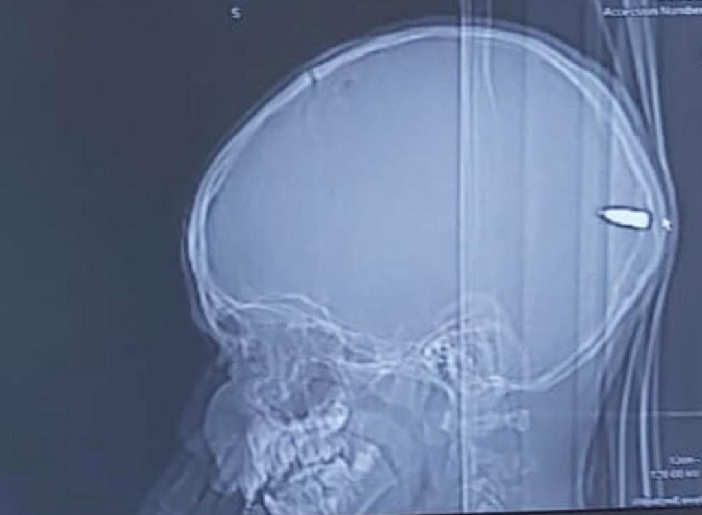 Doctores extraen una bala del cráneo de un niño de 9 años. Noticias en tiempo real