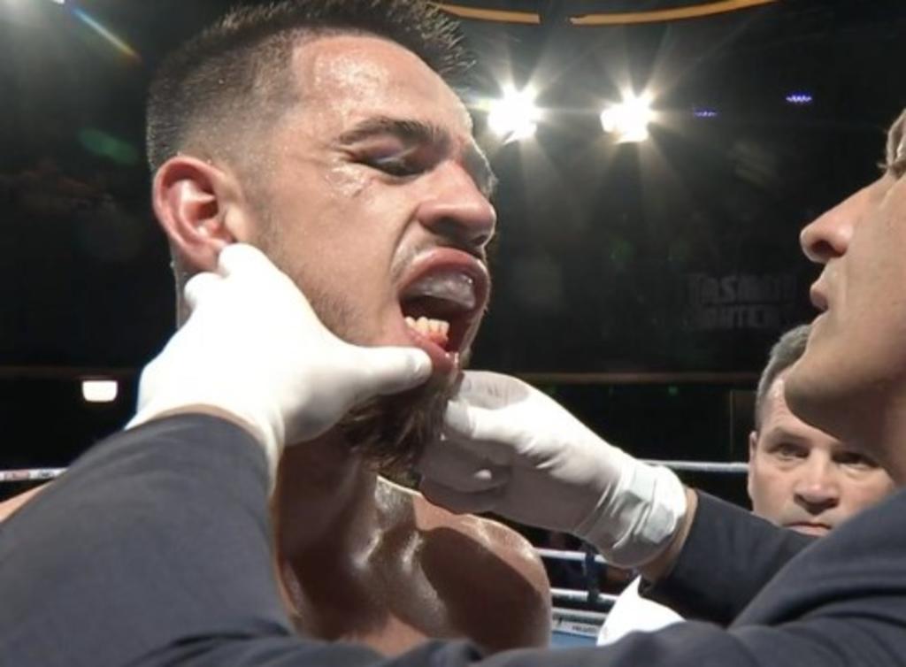 Boxeador impresiona al compartir video de su fractura de mandíbula. Noticias en tiempo real