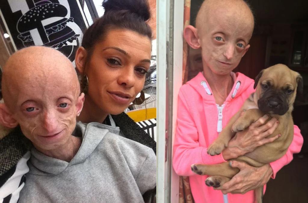 Fallece Ashanti Smith, la adolescente de 18 años que tenía el cuerpo de una anciana de 144, El Siglo de Torreón
