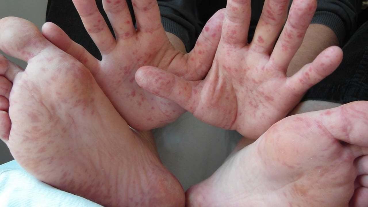 El virus de boca, pies y manos
