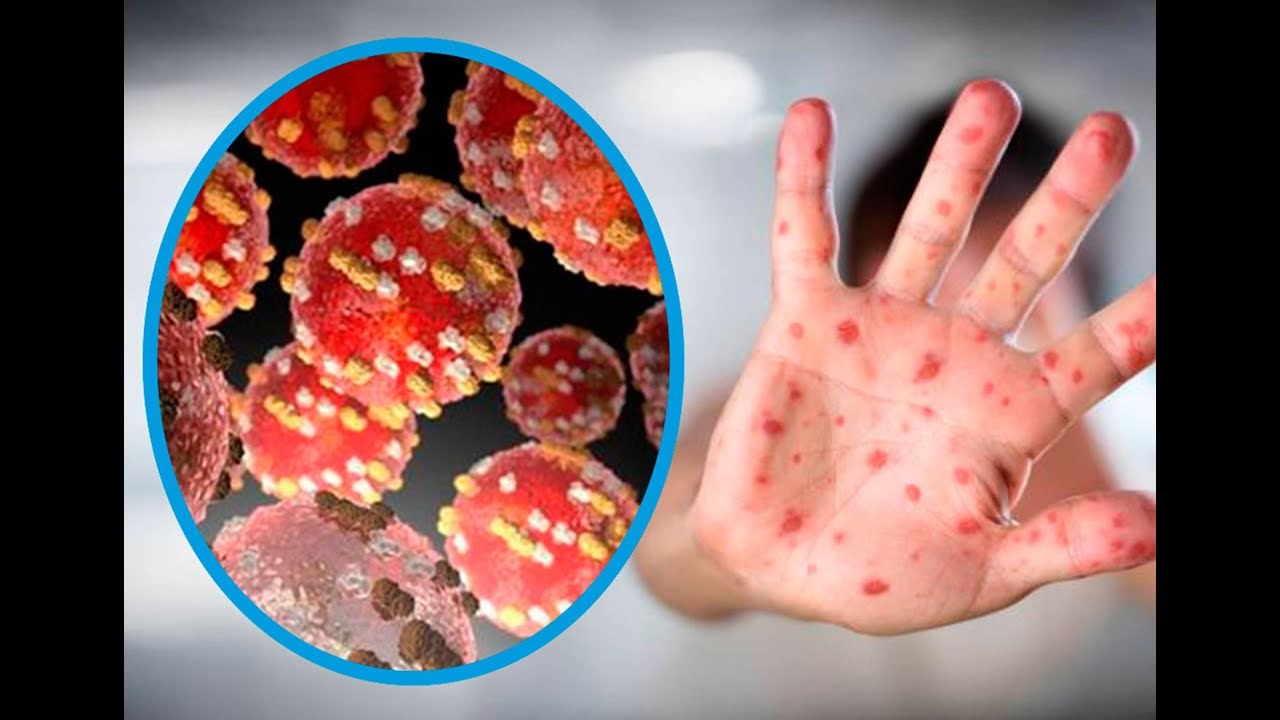 Medidas preventivas contra viruela del mono. Noticias en tiempo real