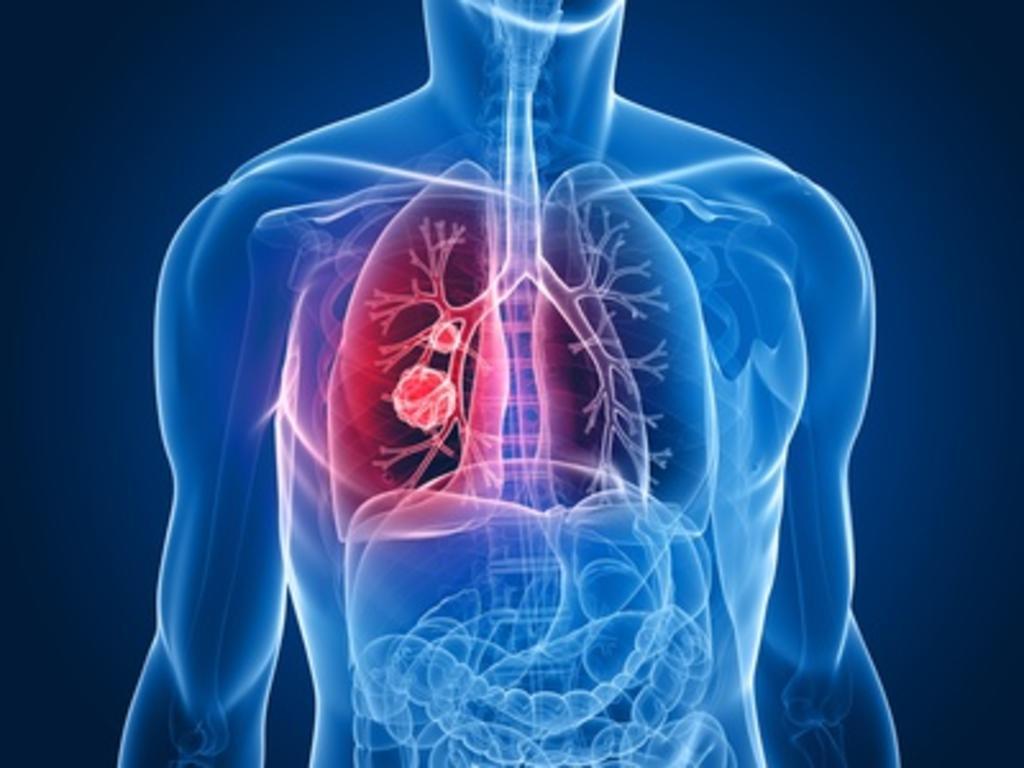 Un nuevo tratamiento aumenta la supervivencia en pacientes con cáncer de pulmón. Noticias en tiempo real