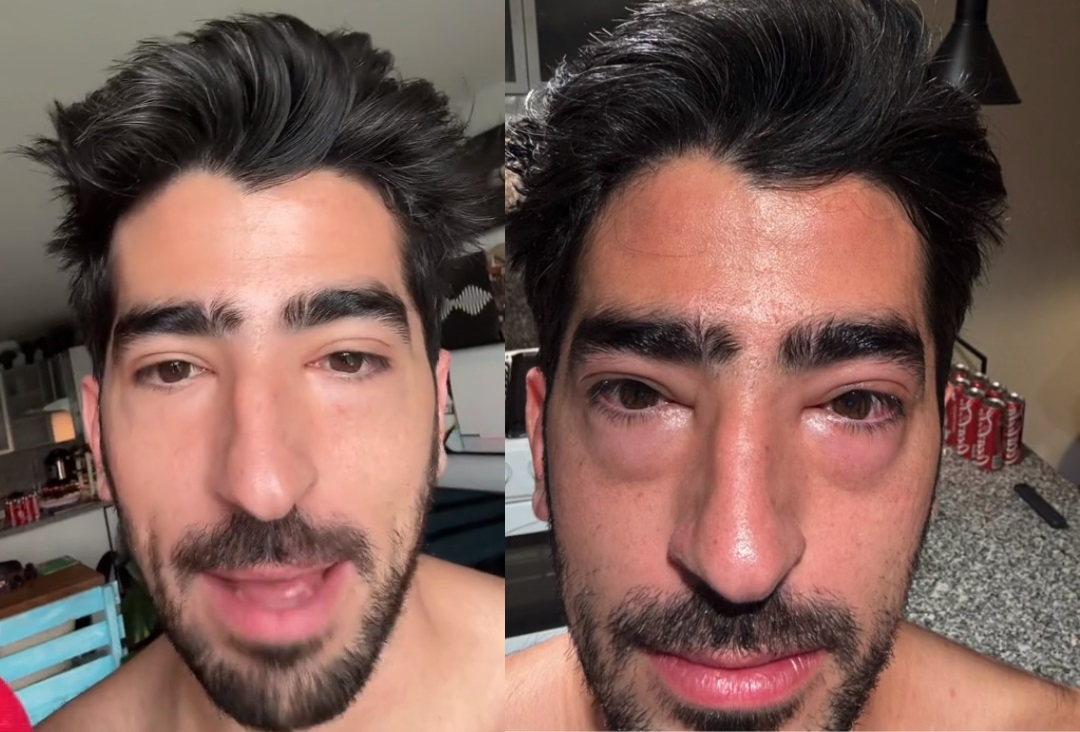 ¿Qué le pasó al 'tiktoker' Jezzini? Preocupa a fans por aparecer con los ojos hinchados