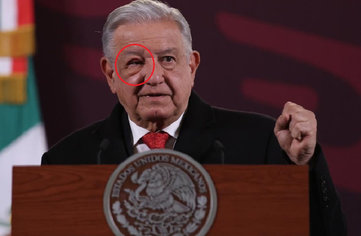 ¿Qué le pasó a AMLO en el ojo?. Noticias en tiempo real