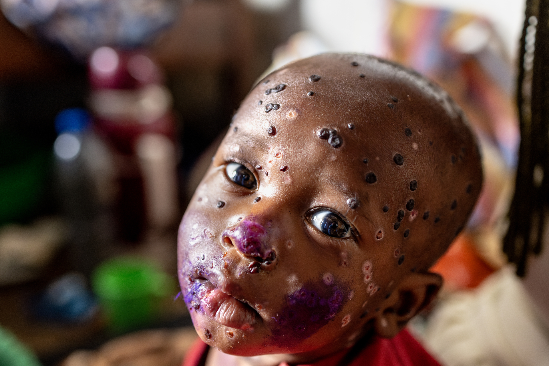 África registra más de 111 mil casos de mpox, van más de mil 700 muertos. Noticias en tiempo real